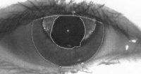 iris not round