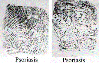 psoriasis